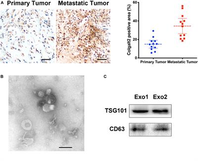 Exosomes Secreted by Adipose-Derived Mesenchymal Stem Cells Foster Metastasis and Osteosarcoma Proliferation by Increasing COLGALT2 Expression